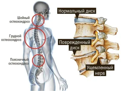 Дегенеративные заболевания позвоночника (2021). Клинические рекомендации.