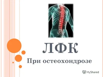 Остеохондроз - симптомы, причины, признаки и методы лечения у взрослых в  «СМ-Клиника»