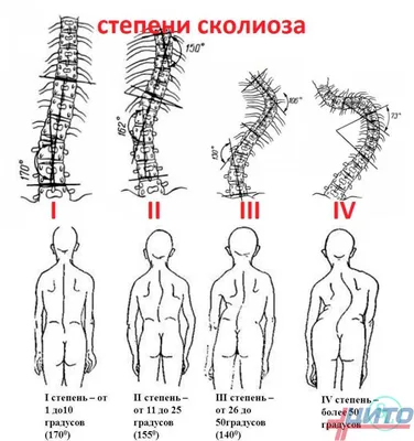 Как и почему упражнения на сгибание (кифотизацию) усугубляют состояние  грудной клетки при сколиозе? | Сколио центр | Дзен