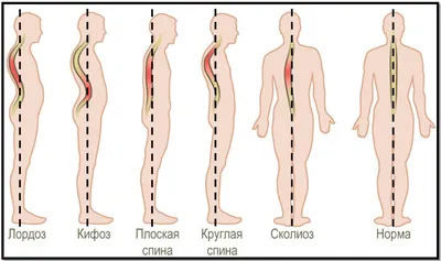 Комплекс упражнений ЛФК при сколиозе