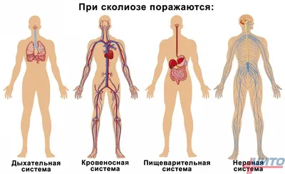 Искривление позвоночника лечение, сколиоз