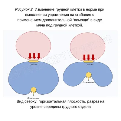 S-Образный сколиоз 1-2-3 степени, причины, лечение грудо-поясничного отдела  позвоночника