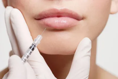 Увеличение Губ или Контурная Пластика Препаратом Juvederm. Результат До и  После. - YouTube