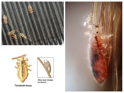Вшивые ресницы: фото с описанием симптомов и лечения