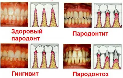 Заболевания полости рта в картинках фотографии