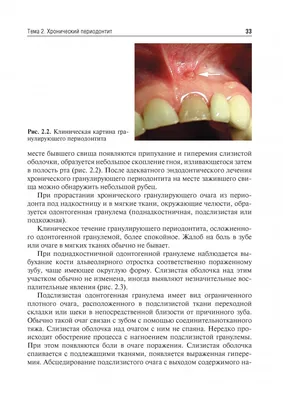 Стоматит – что это, виды, симптомы, лечение у взрослых в «Стоматологии  Комфорта»