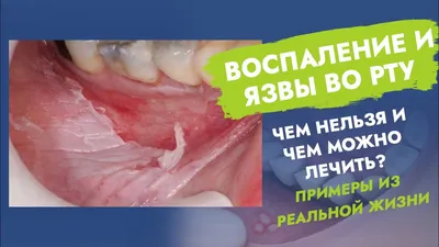 Восполения и заболевания полости рта у диабетиков. Сухость во рту, запах и  налет - во всем виноват высокий сахар в крови? | Заметки диабетика | Дзен