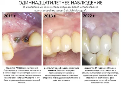 Ось микробиома полости рта и кишечника при желудочно–кишечных заболеваниях  и раке