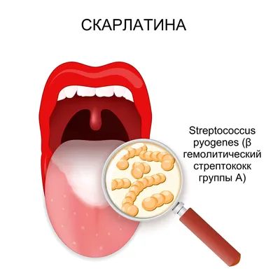 Рак ротоглотки - симптомы, признаки.