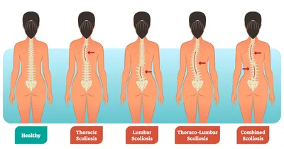 Сколиоз: этиология, классификация, диагностика, лечение - Vertebra