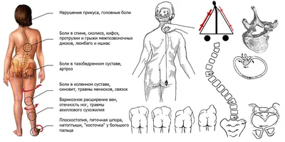 сколиоз - KinesioPro