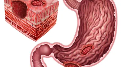Язвенная болезнь желудка и двенадцатиперстной кишки