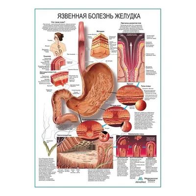 Лечение язвы желудка в Екатеринбурге - Новая больница