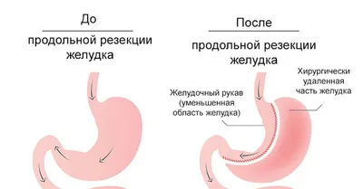 Язвенная болезнь желудка (анатомия человека) плакат глянцевый А1+, плотная  фотобумага от 200г/м2 - купить с доставкой по выгодным ценам в  интернет-магазине OZON (262641567)