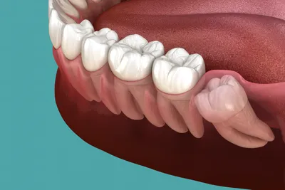 Нужно ли удалять зубы мудрости: нужны ли зубы мудрости, советы экспертов.