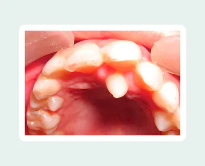 Ретинированный зуб - причины, симптомы, лечение ретинированного зуба