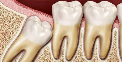 Удаление ретинированого зуба в Томске