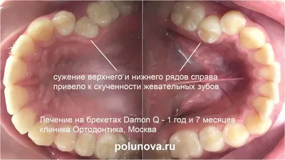 Шатаются зубы у детей и взрослых - почему, что делать, как лечить