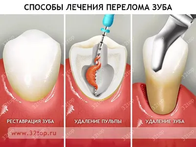 Нужно ли удалять зубы мудрости - показания, противопоказания к удалению  зубов мудрости, как проводится операция