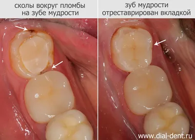 Коронка на зуб: цена в Москве на установку передней зубной коронки и  протезирование в клинике стоматологии