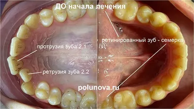 Что делать если потемнел зуб | Причины черноты на зубах