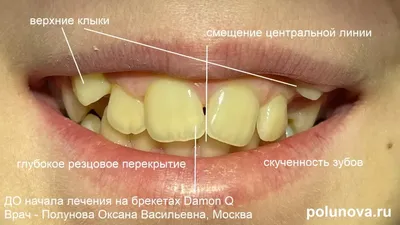 Зуб мудрости у детей? - SHiFA