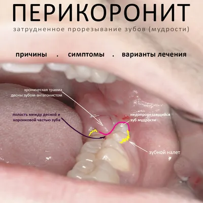 Дистопированный зуб: причины, последствия и лечение