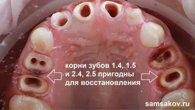 Строение зуба человека, зубы верхней челюсти